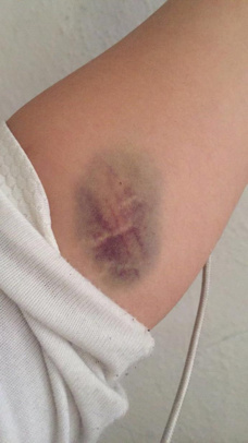 Kan verdikten sonra kolda morarma neden olur?