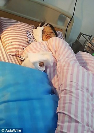 Patlayan telefon çocuğu gözünden ve parmağından etti! - Resim : 2