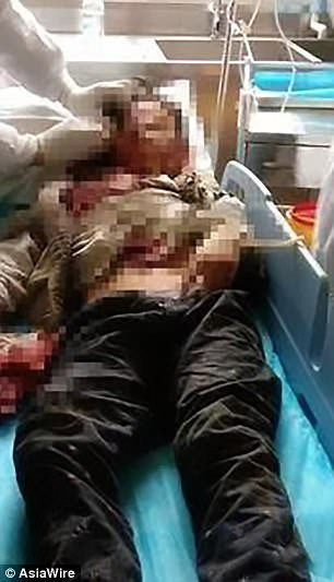 Patlayan telefon çocuğu gözünden ve parmağından etti! - Resim : 1