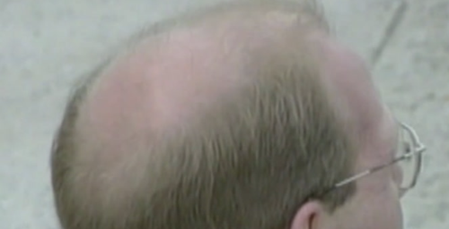 Tek bir şiddetli stres olayı, tekrarlayan saç dökülmesini tetikleyebilir - Resim : 1