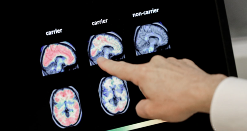 Kan testleriyle Alzheimer’ın ilk belirtileri tespit edilebilir - Resim : 1