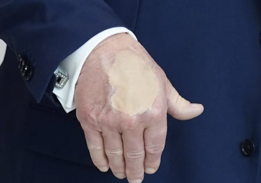 Trump’un elindeki makyaj dikkat çekti: Sağlık endişeleri alevlendi - Resim : 1