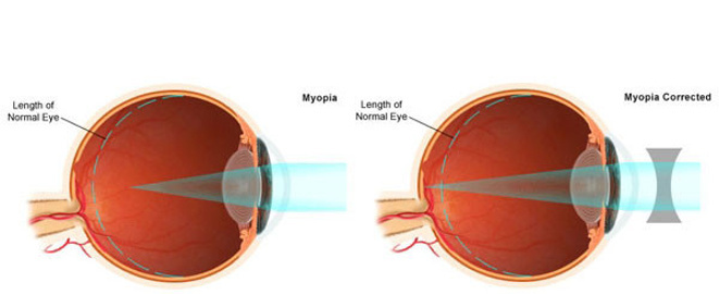 Gelecekte herkes miyop olacak! - Resim : 1