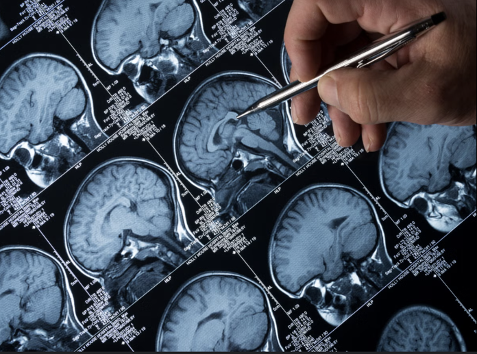 Alzheimer mucizesi: Yeni ilaç hastalığın seyrini 4 yıl yavaşlatıyor - Resim : 1