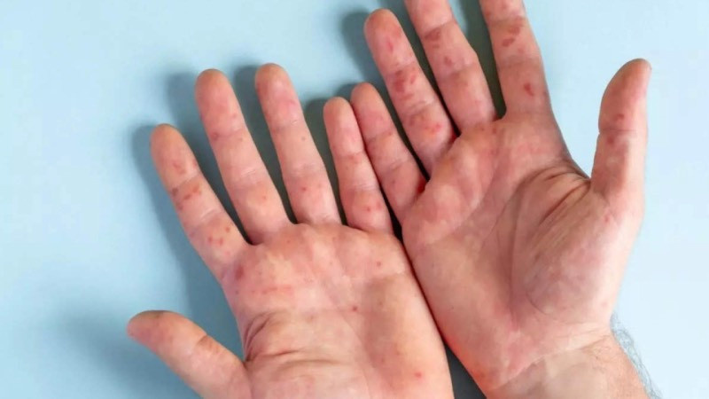 Yeni salgın geliyor! Karşınızda domates gribi! - Resim : 1