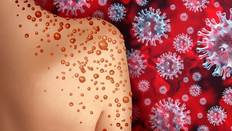 maymun çiçeği arttı