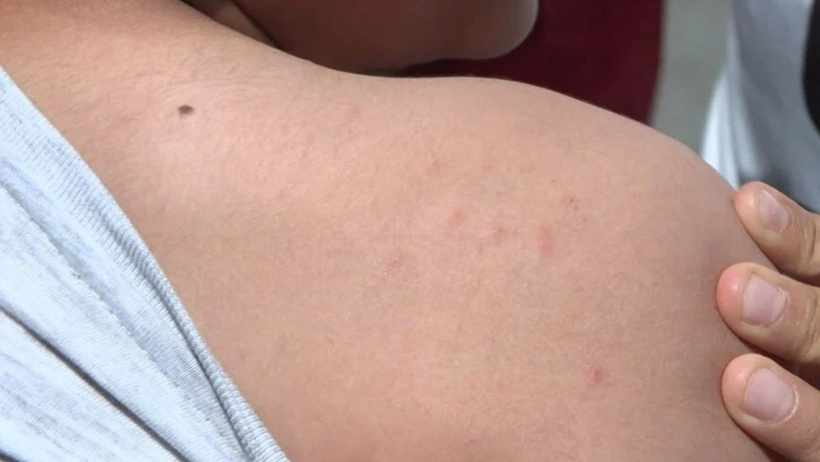 İstanbul'da "sivri sinek" tedirginliği! Sosyal medyadan yardım çağrısı - Resim : 3